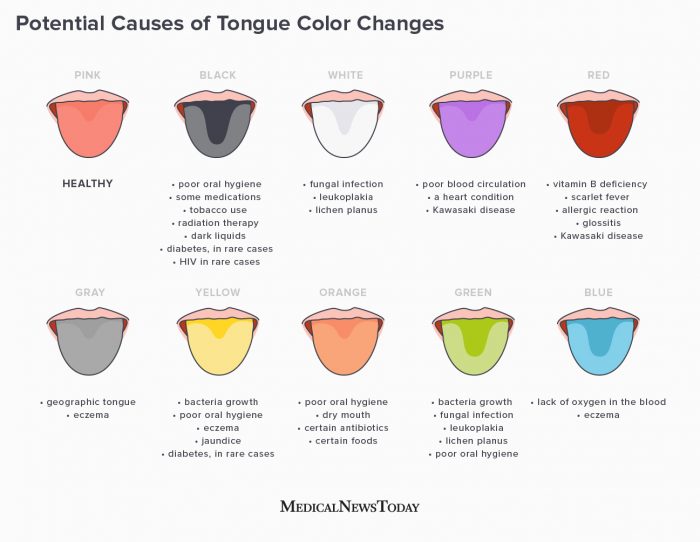Tongue Colour Revealing Your Health