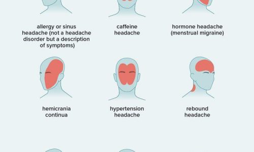 Kinds Of Headaches